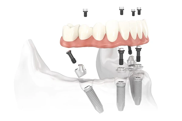 Diagram of All-on-4 Treatment Concept implant bridge placed in the jaw